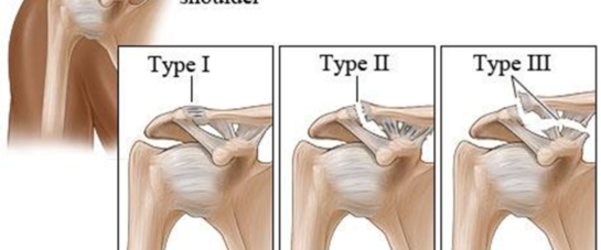 Sports Chiropractic Sydney - AC Joint injury