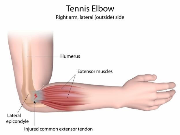 Tennis Elbow treatment - Sydney Spine & Sports Centre